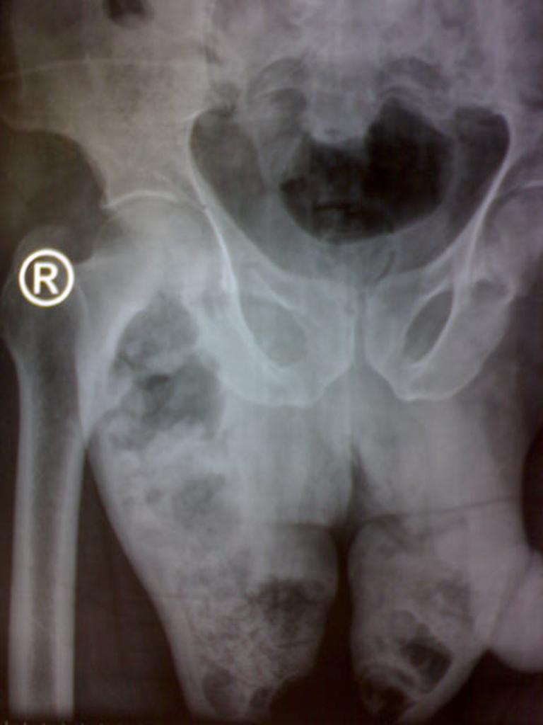 X ray of Fournier gangrene - Case courtesy of Dr Chris O'Donnell, Radiopaedia.org, rID: 16849