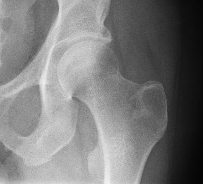 Radiograph of a healthy human hip joint