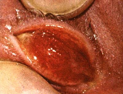 Gonococcal infection of the conjunctiva in a neonate