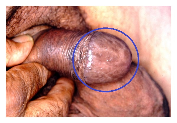 Speckled penis