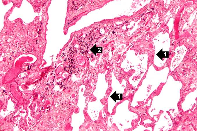 This is a higher-power photomicrograph of lung section. Note the thickening of the alveolar septa (1) and accumulations of anthracotic pigment (2).