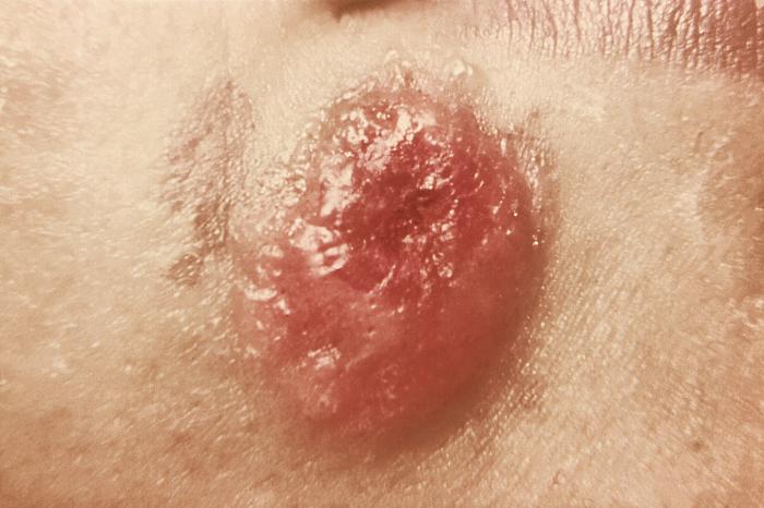 Right lower lip and chin region of a 25 year old woman, who had been accidentally infected on her face after her daughter was vaccinated against smallpox.Adapted from Public Health Image Library (PHIL), Centers for Disease Control and Prevention.[3]