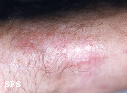 Woringer kolopp disease. Adapted from Dermatology Atlas.[3]