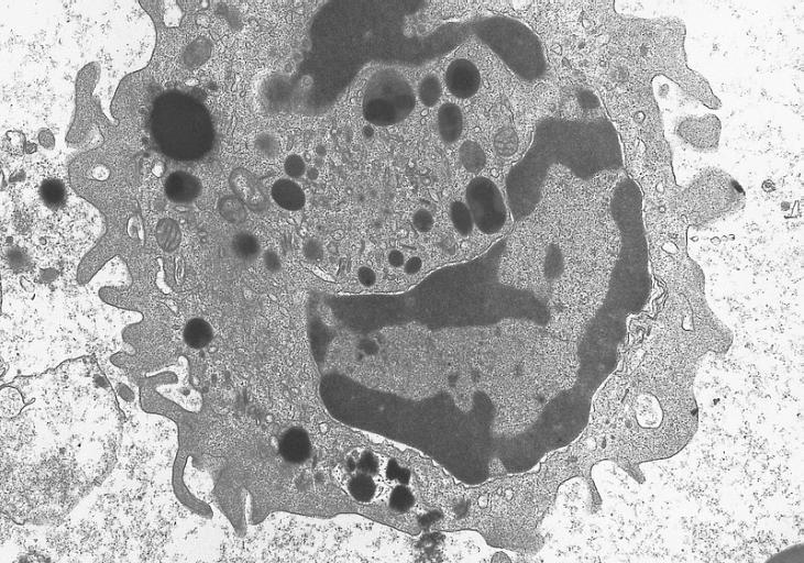 BONE MARROW: HYPEREOSINOPHILIC SYNDROME: ULTRASTRUCTURE Electron micrograph of an abnormal eosinophil from the specimen in figure 274B. There is a decreased number of granules. The majority of the granules present are homogeneous in contrast to normal eosinophil granules which have a dense core surrounded by a less dense capsule. (Uranyl acetate-lead citrate stains, X20,000)