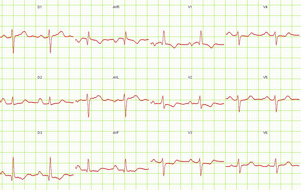 Pulmonary embolism. S1-Q3 and signs of right frontal axis are shown. Image courtesy of Dr Jose Ganseman Dr Ganseman's webpage: An ultimate source of EKG