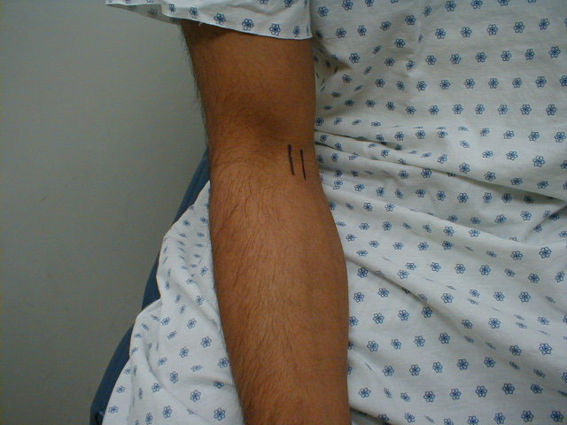 Biceps tendon: The tendon is outlined