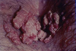 Condyloma Acuminatum: Anogenital Warts Image obtained from U.S. Department of Veterans Affairs - Image Library [7] (Paul A. Volberding, MD, University of California San Francisco)