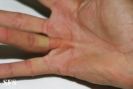 Dupuytren contracture. Adapted from Dermatology Atlas.[2]