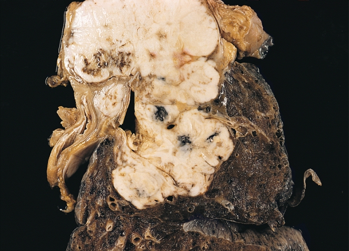 Gross pathology: Large cell carcinoma of the lung