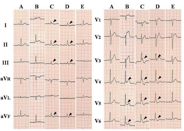 The time course of twelve-lead ECG in a 52-year-old man with vasospastic angina. ECGs were obtained prior to the ischemic attack (A), at the onset of chest pressure (B), immediately before ventricular fibrillation (C), after defibrillation and administration of intravenous lidocaine and magnesium (D), and 2 days after the episode (E). Osborn waves (arrowheads) were best seen in the inferior and lateral leads around the occurrence of ventricular fibrillation. In contrast to hypothermic patients, the tracing shows sinus tachycardia and short QT intervals.[11]