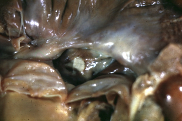 Ventricular Septal Defect (Subvalvular) Repaired: Gross, fixed tissue, close-up view of Dacron patch. Nearly completely covered with fibrous tissue