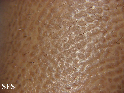 .Lichen amyloidosus Adapted from Dermatology Atlas.[5]
