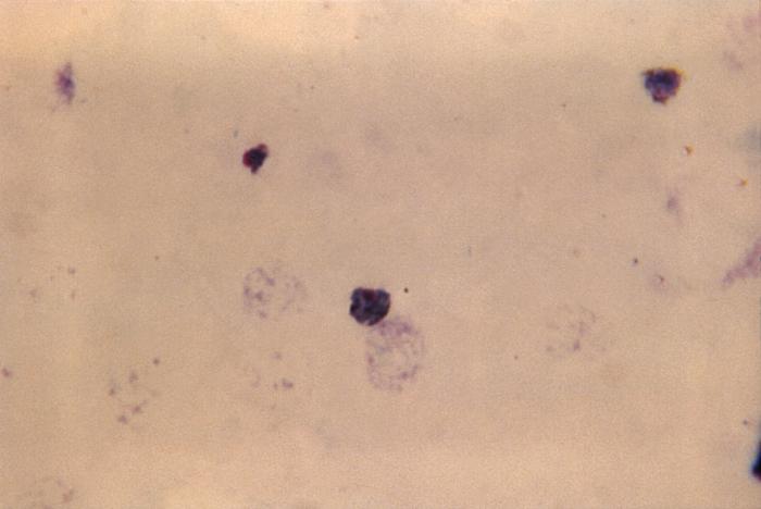 Thick film Giemsa stained micrograph depicts a mature Plasmodium ovale trophozoite Adapted from Public Health Image Library (PHIL), Centers for Disease Control and Prevention.[6]
