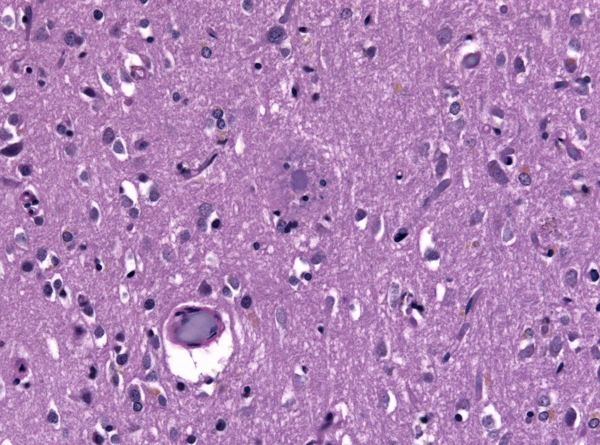 File:Neuritic plaque HE stain.jpg