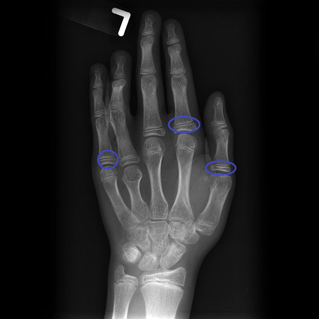 File:Turner-syndrome-hand.jpg