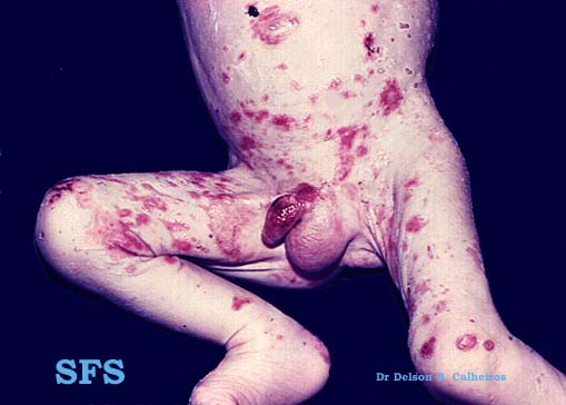 Acrodermatitis enteropathica. [http://www.atlasdermatologico.com.br/disease.jsf?diseaseId=12