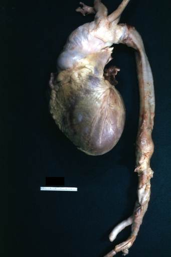 Dissecting Aneurysm: Gross fixed tissue external view of heart aortic arch and descending aorta showing dilated first and second portion of arch from anterior projection.