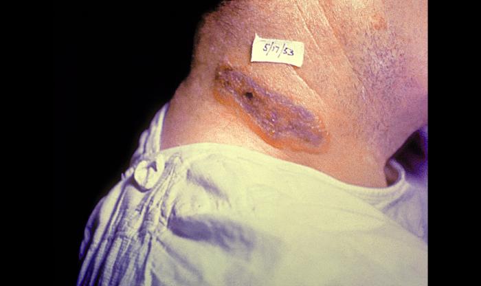 "Anthrax skin lesion on neck of man. Cutaneous”Adapted from Public Health Image Library (PHIL), Centers for Disease Control and Prevention.[3]