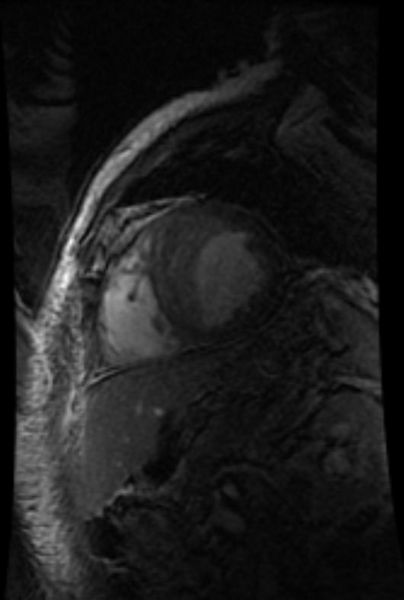 MRI: A large left ventricular clot in patient with acute myocardial infarction.