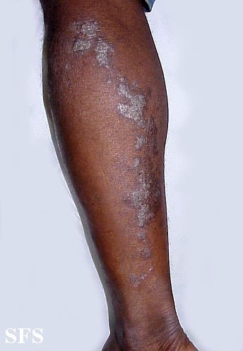 Lichen planus linearis. Adapted from Dermatology Atlas.[1]