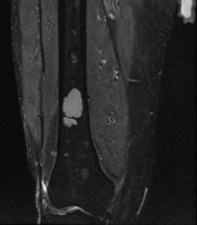 File:Multiple myeloma MRI101.jpg