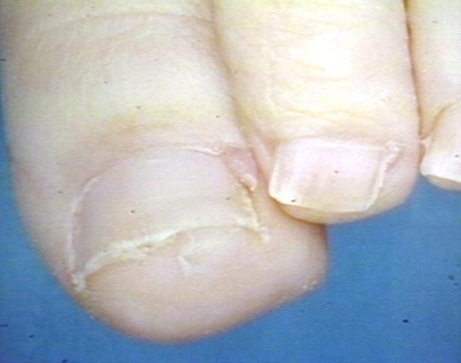 Tuberous sclerosis, Periungual Fibroma; Lateral Side of Left Great Toe Nail