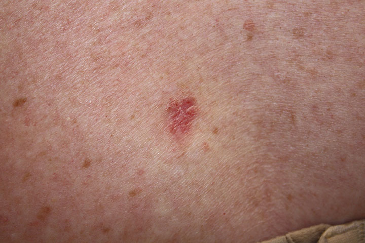 File:Basal cell carcinoma, superficial.jpg