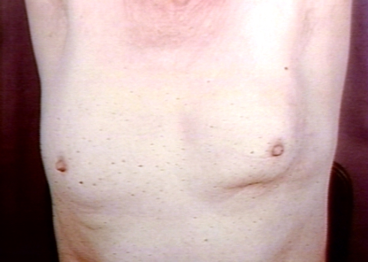 Breast carcinoma; a small palpable hard lump