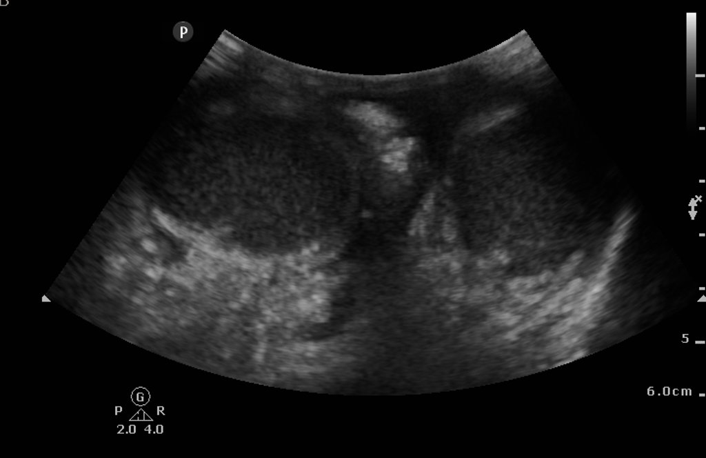 Ultrasound of Fournier gangrene - Case courtesy of Dr Chris O'Donnell, Radiopaedia.org, rID: 16849