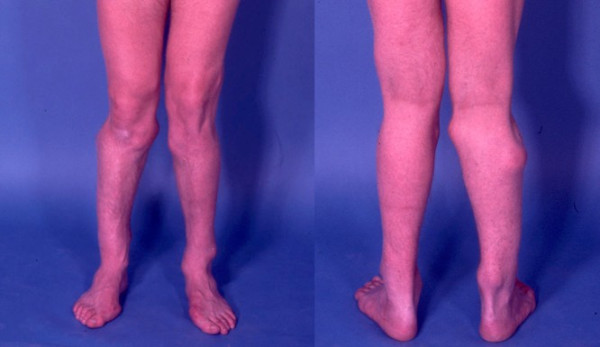 Multiple osteochondroma: Image shows multiple lumps leading to deformity.[3]