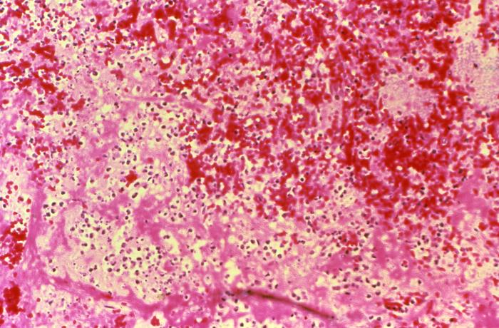 Histopathology of spleen in fatal human plague. Necrosis and Yersinia pestis Adapted from Public Health Image Library (PHIL), Centers for Disease Control and Prevention.[18]