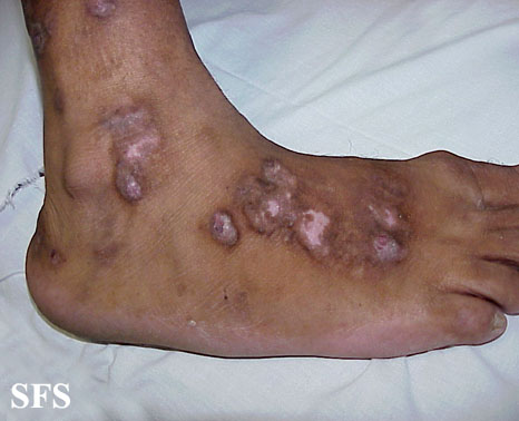Prurigo nodularis. With permission from Dermatology Atlas.[9]