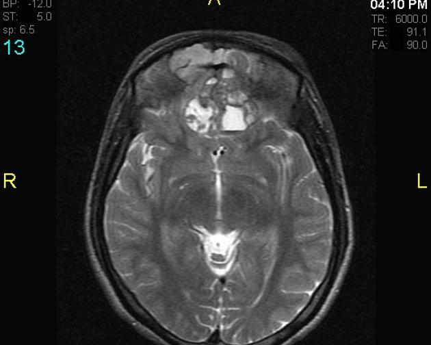 MRI showing T2 esthesioneuroblastoma[2]