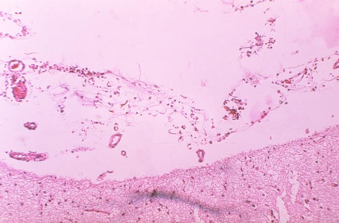 "Hematoxylin-eosin (H&E)-stained photomicrograph of a meningeal tissue sample revealed the presence of histopathologic changes indicative of hemorrhagic meningitis in a case of fatal human anthrax.” Adapted from Public Health Image Library (PHIL), Centers for Disease Control and Prevention.[21]