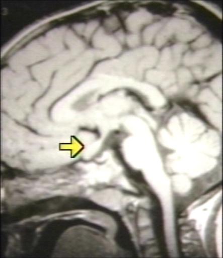 MRI of optic nerve glioma