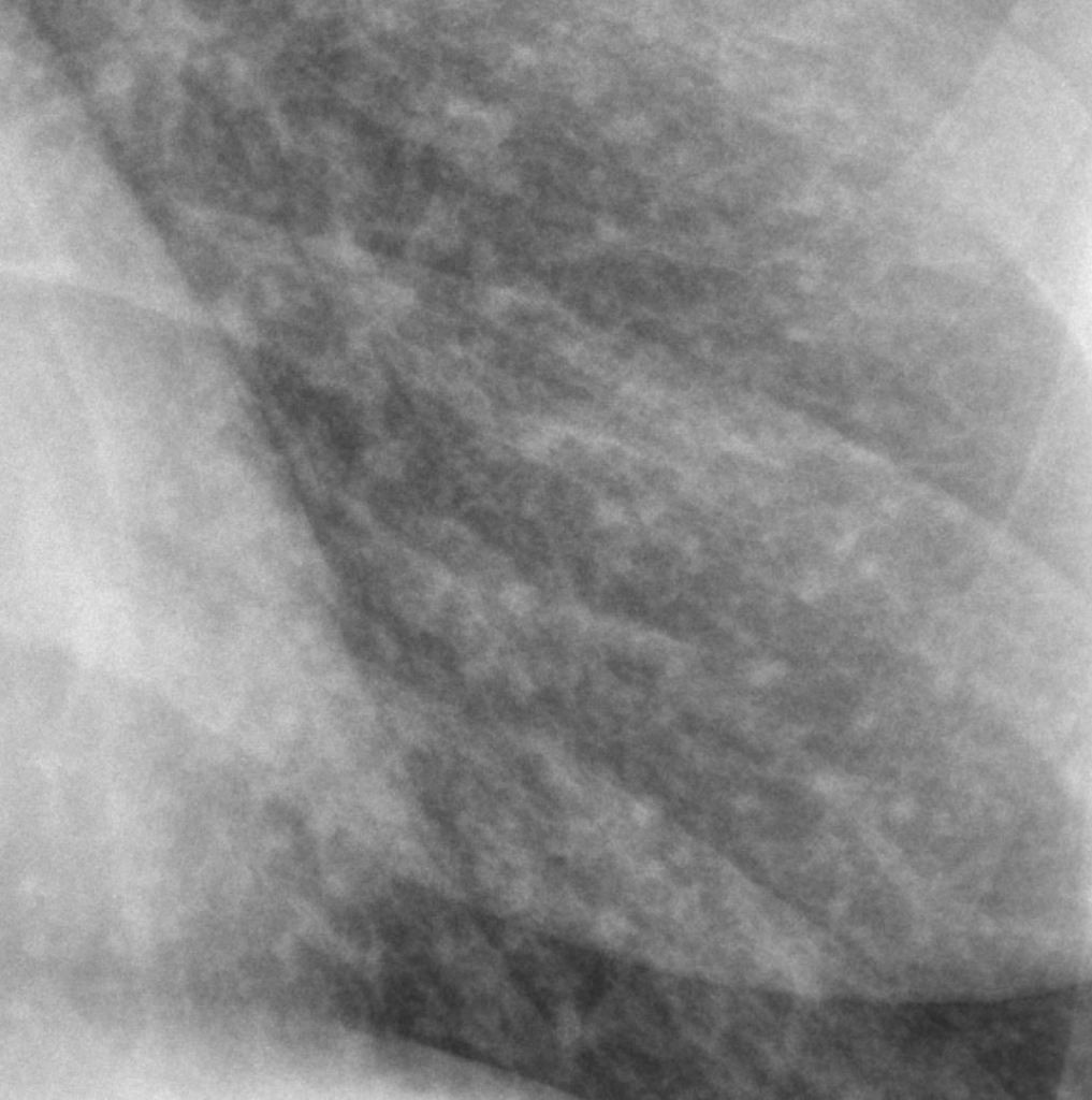 Miliary lung nodules consistent with prior and healed varicella pneumonia.[3]