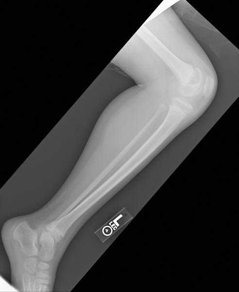Hemophilic arthropathy involving the bilateral knees - Source: radswiki.net