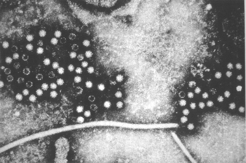 TEM micrograph of hepatitis E virions.