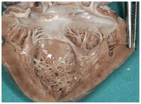 File:Left ventricular hypertrabeculation.jpg