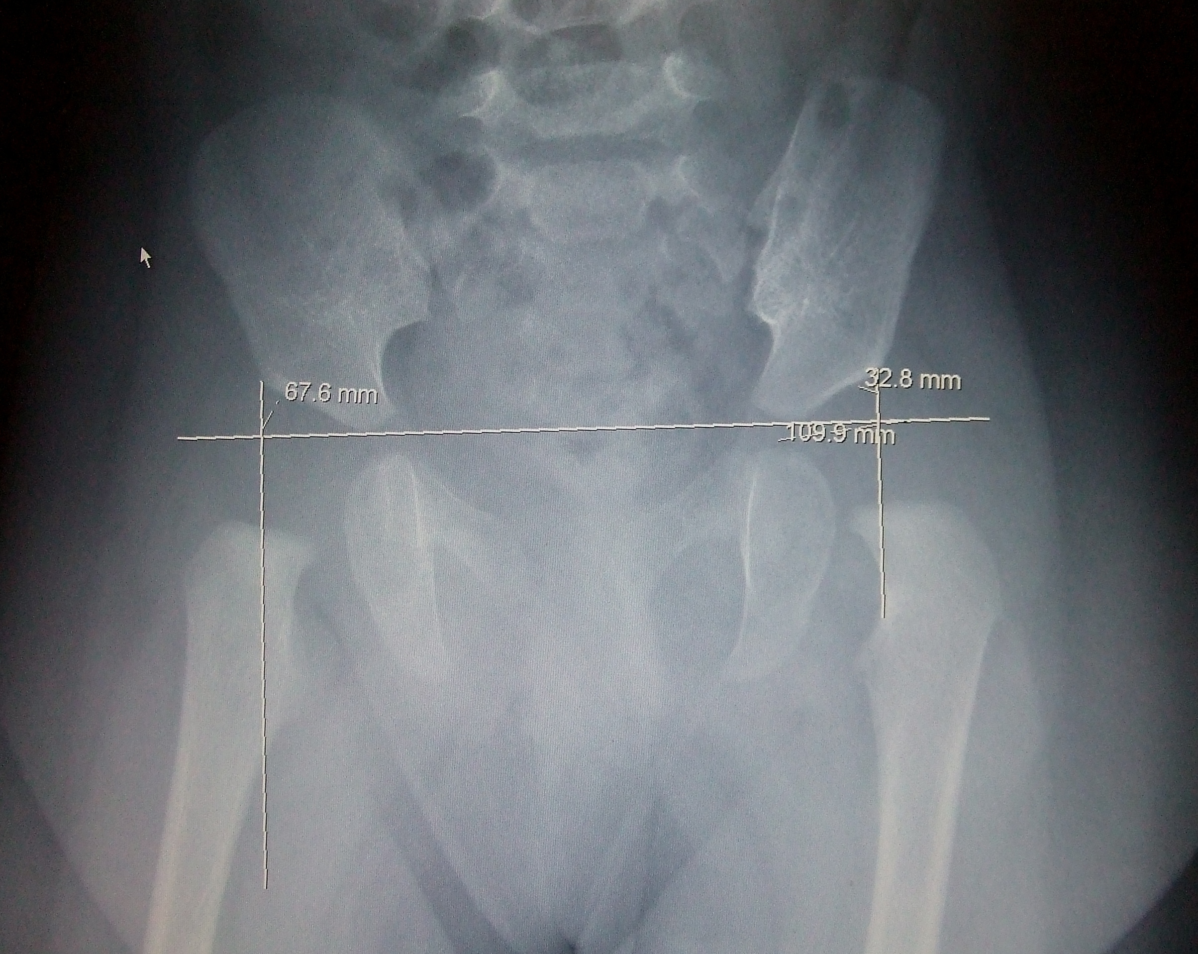 X-Ray showing calculations for working out hip dysplasia