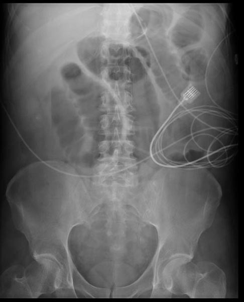 File:Small bowel obstruction 001.jpg