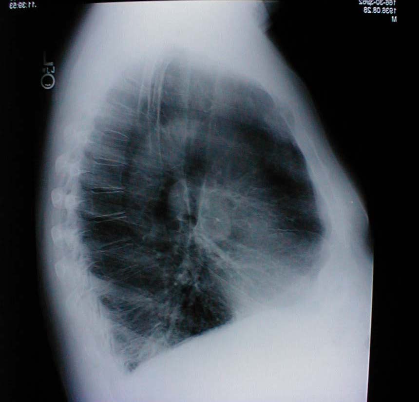 Accompanying lateral chest x-ray also demonstrates increased anterior-posterior diameter as well as diaphragmatic flattening.