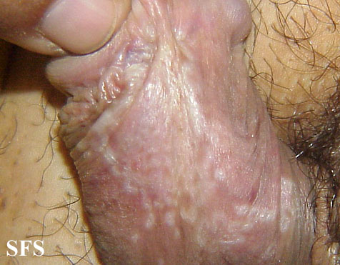 File:Lichen sclerosus et atrophicus14.jpg