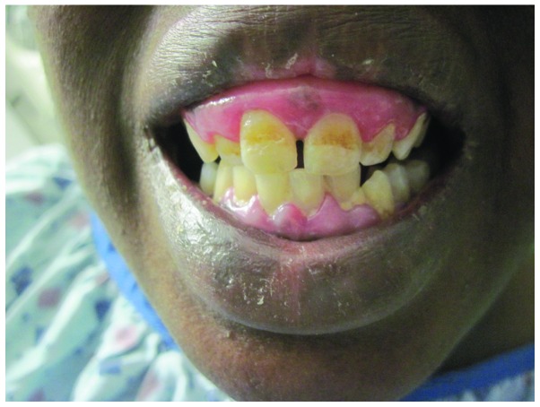 Dental abnormalities