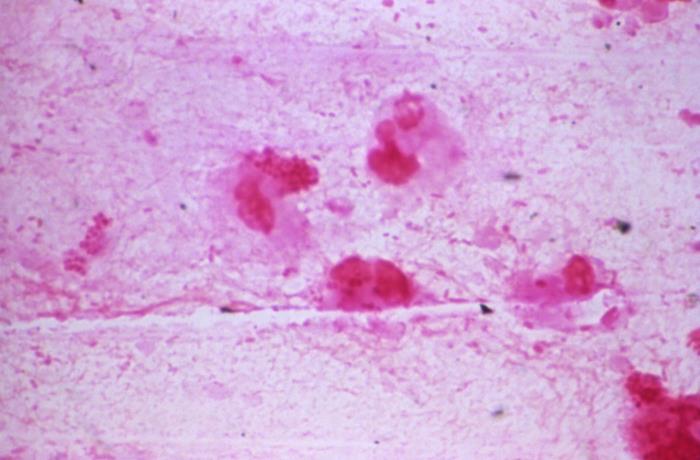 Photomicrograph reveals Gram-negative rods, and Gram-negative cocci, which were determined to be Haemophilus influenzae, and non-meningococcal Neisseria sp. organisms in sample of a transtracheal aspirate (1000x mag). From Public Health Image Library (PHIL). [9]