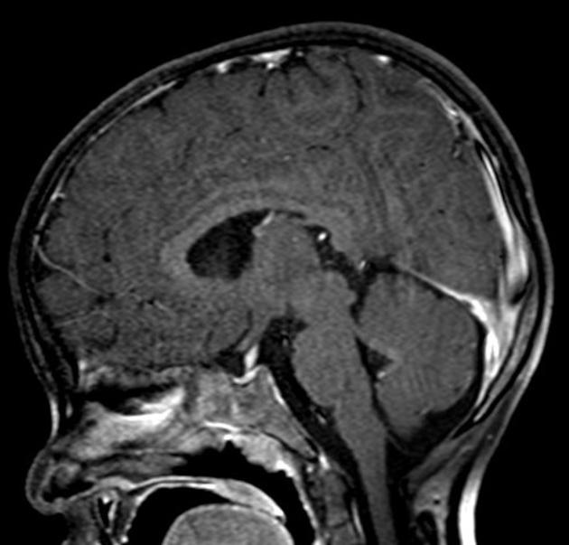 Brain MRI reveals destructive lesion of the sphenoid wing on right side with thickening of the pituitary stalk and enhancing soft tissue in the sella and along the posterior aspect of the clivus[1]