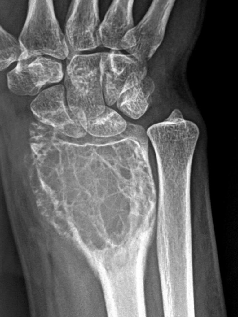 Giant cell tumor: located on distal radius Adapted from Radiopedia