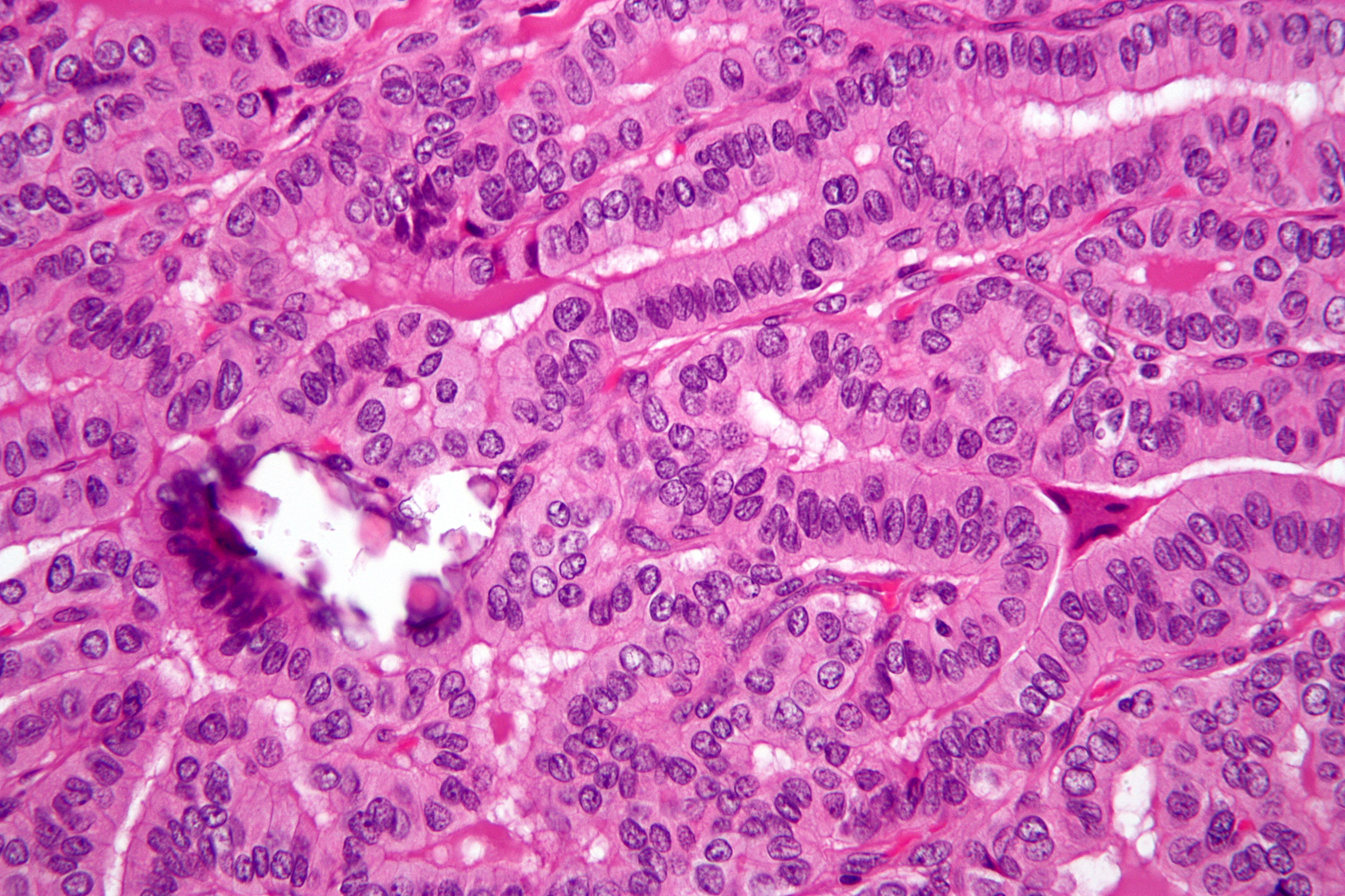File:Papillary thyroid carcinoma tall cell var high mag.jpg