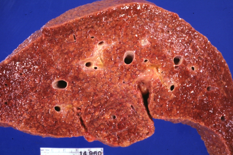 Micronodular cirrhosis: Gross (an excellent example)