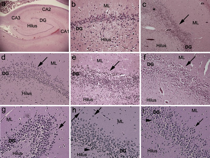 File:Focal granule cell dispersion in the dentate gyrus (DG).jpg